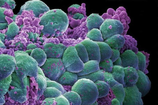 Le cancer bientôt vaincu par des chercheurs israéliens?